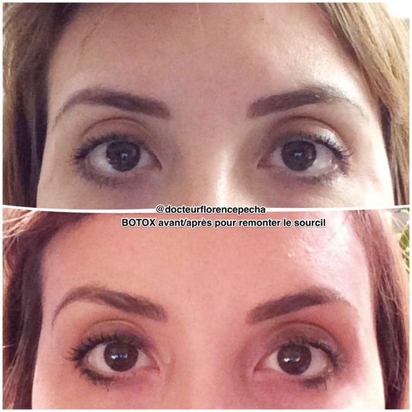 Remonter le sourcil grâce aux injections de Botox à Cannes par le Dr Pecha 2