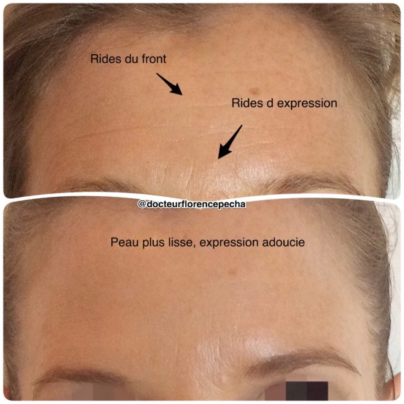 Effacer les rides du front avec les injections d'AH à Cannes du Dr Pecha