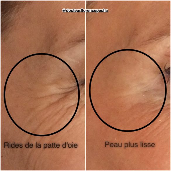 Rides de la patte d'oie: avant/après injections d'AH à Cannes, Dr Pecha