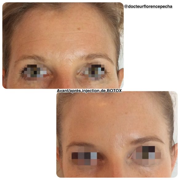 Traiter les rides du front avec les injections de Botox à Cannes, Dr Pecha