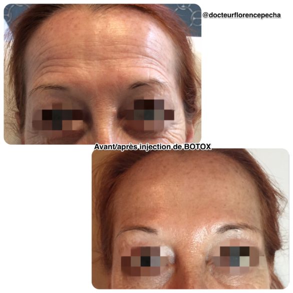 Résultat avant/après des injections de Botox à Cannes du Dr Pecha