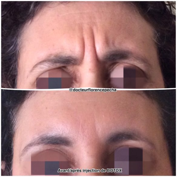 Résultat avant/après injections de Botox à Cannes avec le Dr Pecha 2