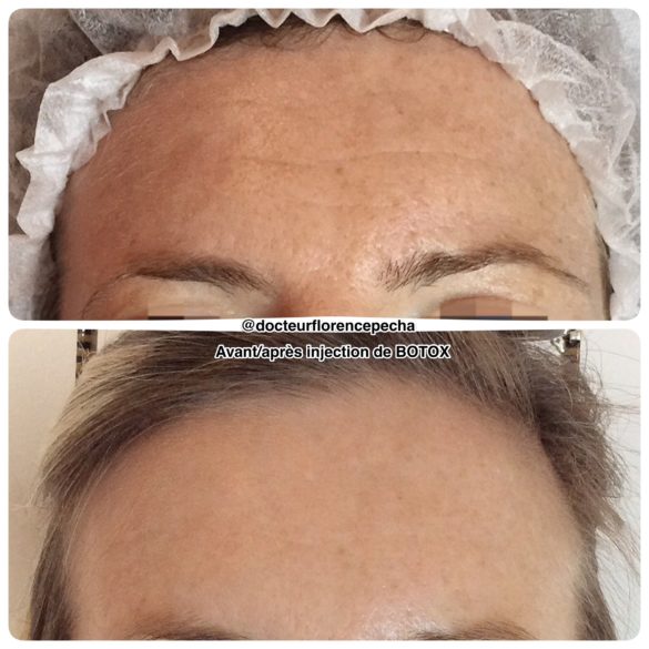 L'avant/après une séance d'injection de Botox à Cannes avec le Dr Pecha 2