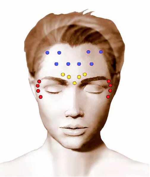 Les zones d'injection du Botox au visage à Cannes, Dr Pecha